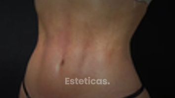 Lipoescultura - Dr. Honorio Labaronnie