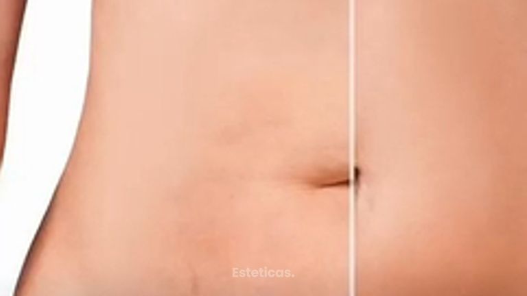 Abdominoplastia post embarazo - Dr. Rodolfo Villavicencio