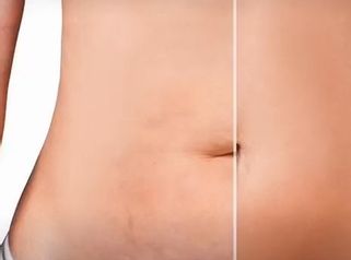 Abdominoplastia post embarazo - Dr. Rodolfo Villavicencio