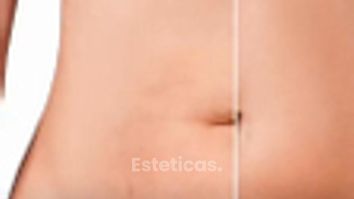 Abdominoplastia post embarazo - Dr. Rodolfo Villavicencio