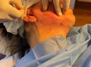 Endolift cara y cuello - Dr. Diego Cunille