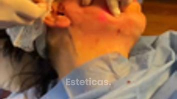 Endolift cara y cuello - Dr. Diego Cunille