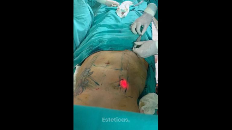 Liposucción 