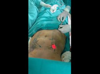 Liposucción 
