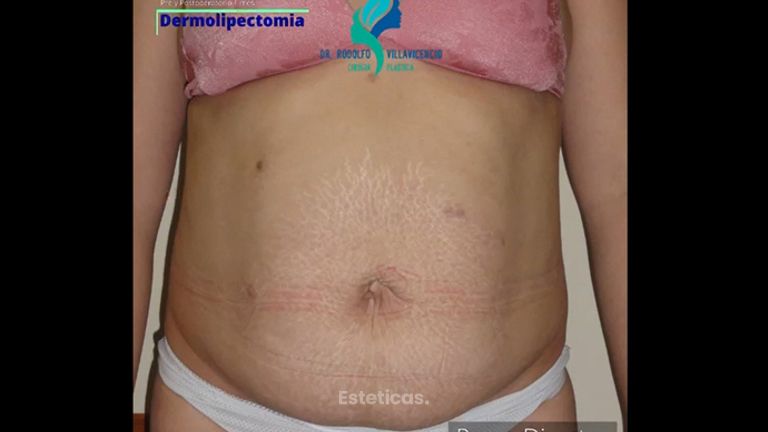 Dermolipectomía - Dr. Rodolfo Villavicencio