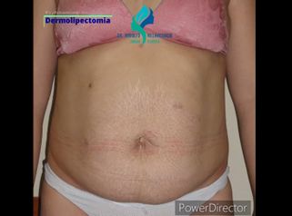 Dermolipectomía - Dr. Rodolfo Villavicencio