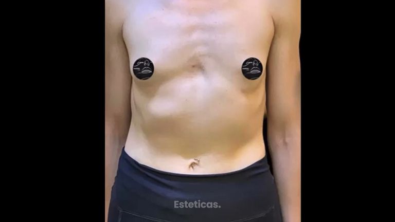 Aumento mamas - Dr. Santiago Rosales Castiglione