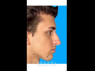 Rinoplastia - Dr. Ariel Kochol