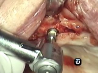 Consigue la mejor dentadura