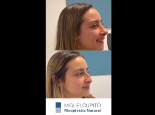 Rinoplastia - Dr. Miguel Ángel Cupito