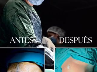 Liposucción - Dr. Gustavo Godoy