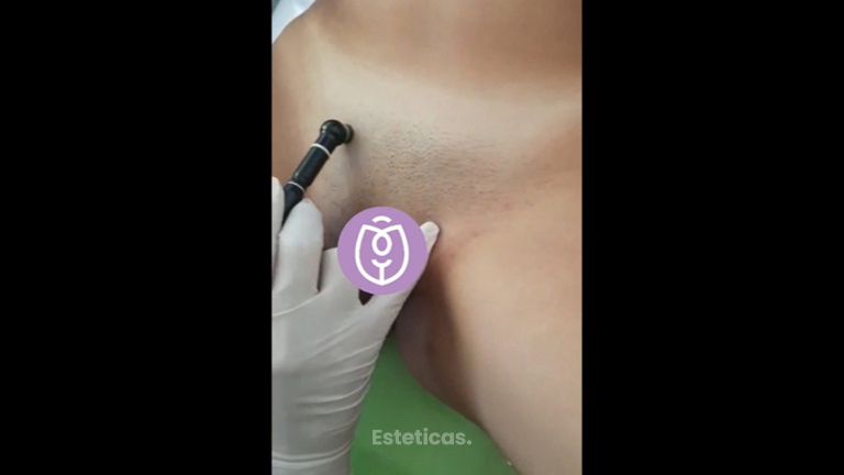 Peeling vaginal - Dra. Lorena Pedroza y Dr. Gonzalo Rueda