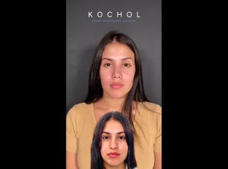 Rinoplastia - Dr. Ariel Kochol