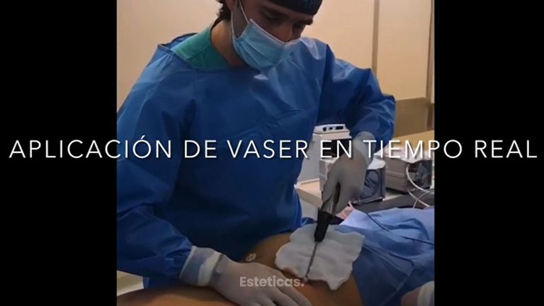 Lipo Vaser - Dr Damián Galeazzo y Equipo