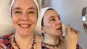 Tratamiento de Ojeras y Pomulos - Dra. Romina Neira