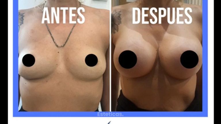 Aumento de mamas
