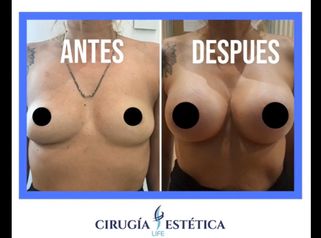 Aumento de mamas