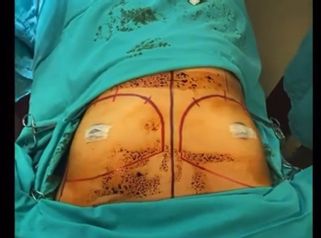 Aumento de mamas - Dr. Fabian Vargas Carrasco