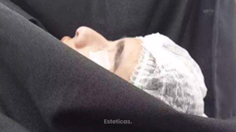 Rinoplastia - Dr. Lucas Sánchez