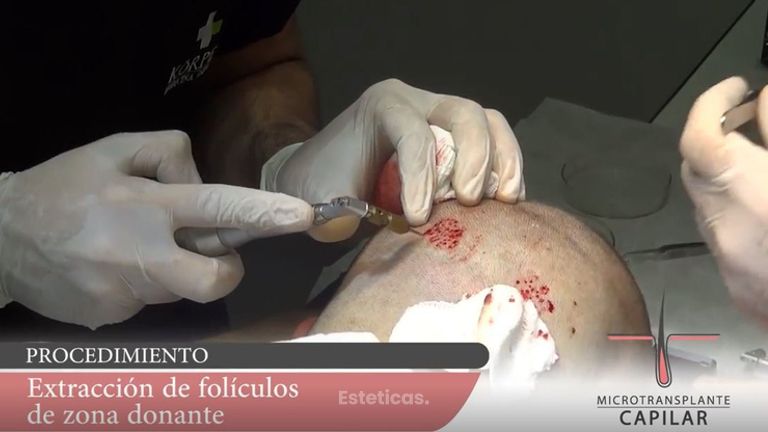 MICROTRANSPLANTE CAPILAR - TECNICA FUE -  KORPER MEDICINA ESTETICA