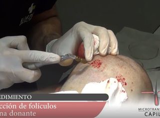 MICROTRANSPLANTE CAPILAR - TECNICA FUE -  KORPER MEDICINA ESTETICA