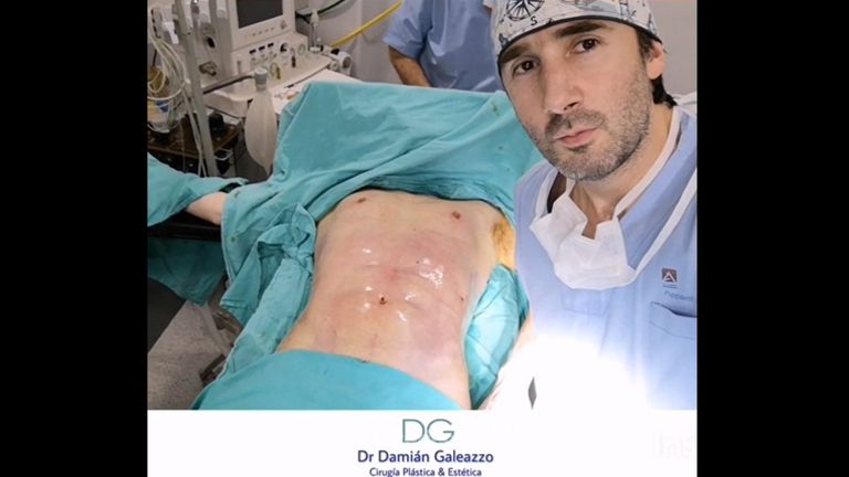 Lipoescultura con Marcación Abdominal