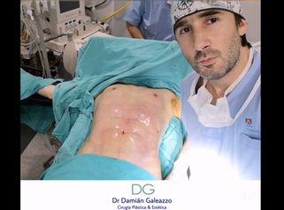 Lipoescultura con Marcación Abdominal