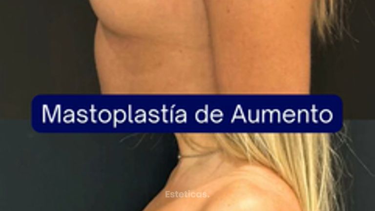 Aumento mamas - Dr. Agustín Matia