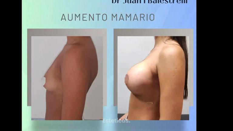 Aumento Mamario - Dr. Juan Ignacio Balestrelli
