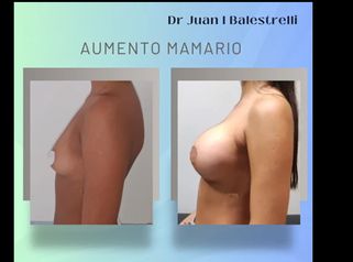 Aumento Mamario - Dr. Juan Ignacio Balestrelli