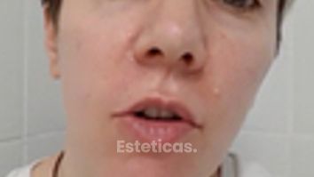 Testimonial - Ojeras y Pomulos - Dra. Romina Neira