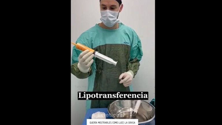 Lipotransferencia - Dr. Santiago Rosales Castiglione