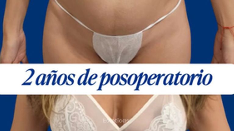 Dermolipectomia - Dr. Damián Wengrowicz