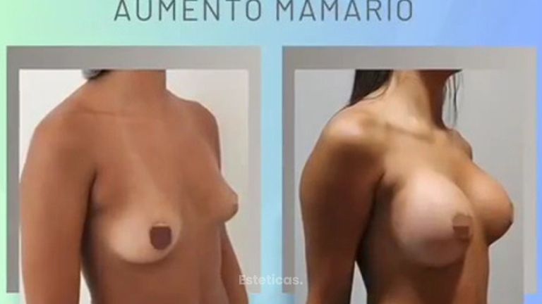 Aumento mamario - Dr. Juan Ignacio Balestrelli