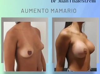 Aumento mamario - Dr. Juan Ignacio Balestrelli