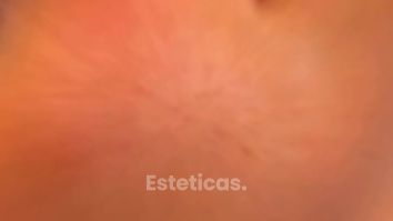 Relleno de labios - Dr. Gustavo Godoy