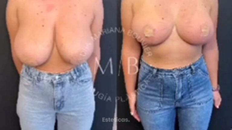 Reducción Mamaria -Dra. Mariana Bouvier