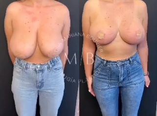 Reducción Mamaria -Dra. Mariana Bouvier
