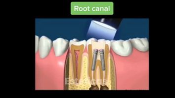 Implante dental - Dental Advance