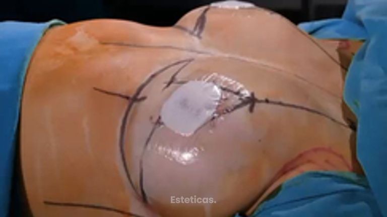 Reducción + Mastopexia - Dr. Fernando Glaria