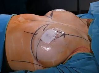 Reducción + Mastopexia - Dr. Fernando Glaria