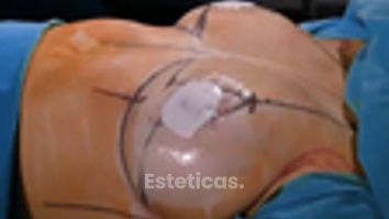 Reducción + Mastopexia - Dr. Fernando Glaria