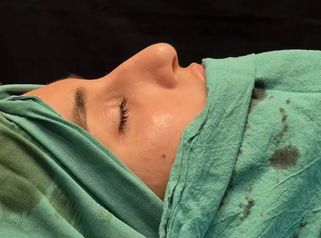 Rinoplastia - Dr. Damián Wengrowicz