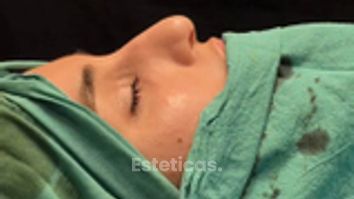 Rinoplastia - Dr. Damián Wengrowicz