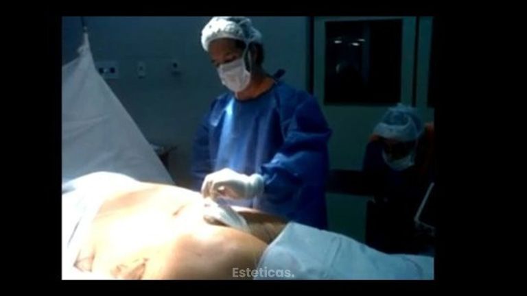 Lipoaspiración asistida por láser