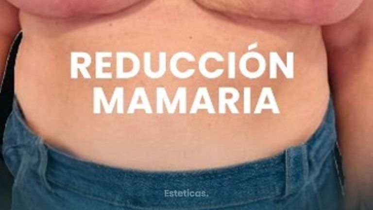 Reducción de Mamas - Dra. Laura Marin