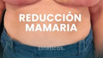 Reducción de Mamas - Dra. Laura Marin