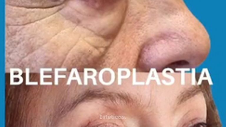 Blefaroplastia - Dra. Laura Marin