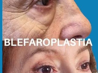 Blefaroplastia - Dra. Laura Marin