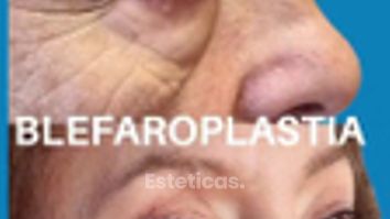 Blefaroplastia - Dra. Laura Marin